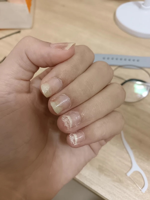 hình ảnh nấm kẽ móng tay