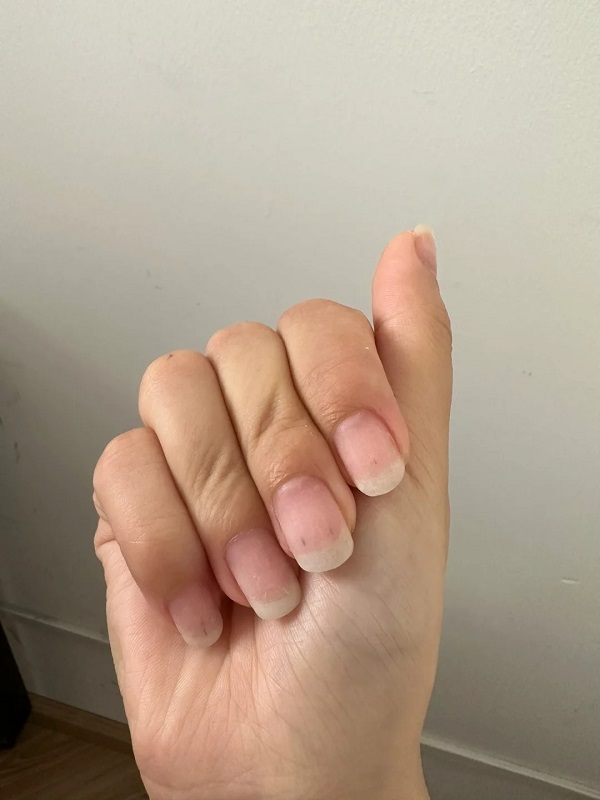móng tay có sọc đen mờ