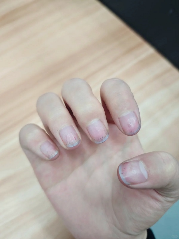 móng tay có sọc đen nhỏ là bệnh gì