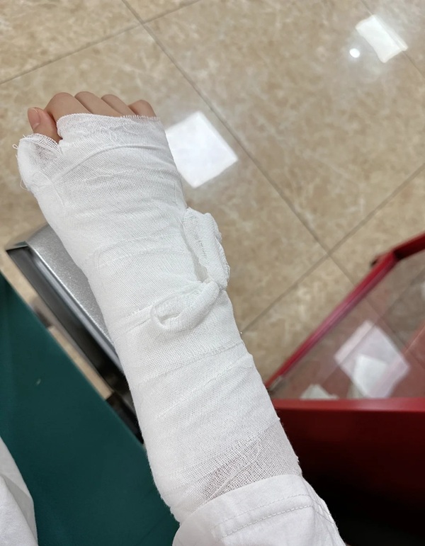 hình ảnh gãy tay 25