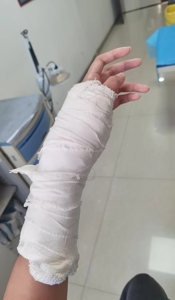 hình ảnh gãy tay 5
