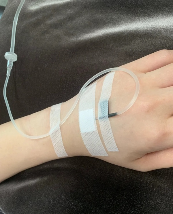 ảnh truyền nước ở tay nam 4